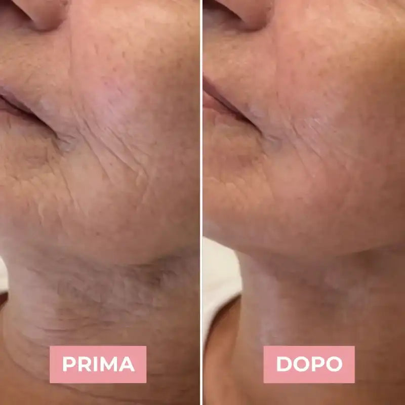 Lip Plumper Acido Ialuronico Thedermaskin labbra e contorno occhi – effetto rimpolpante